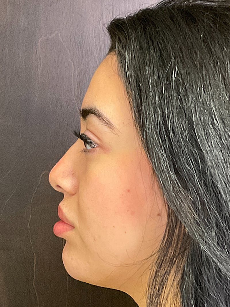 Full Face Filler Before & After Gallery - Patient 131838951 - Image 10