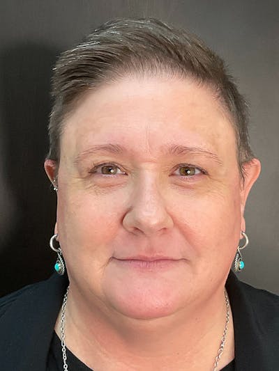 IPL Before & After Gallery - Patient 131839196 - Image 2