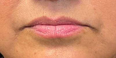 Lips Before & After Gallery - Patient 131839389 - Image 1