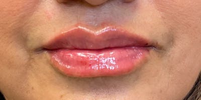 Lips Before & After Gallery - Patient 131839389 - Image 2