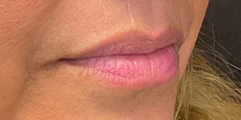 Lips Before & After Gallery - Patient 131839389 - Image 3