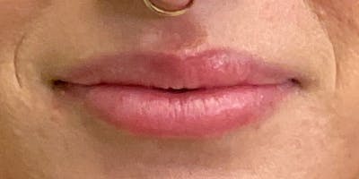 Lips Before & After Gallery - Patient 131839390 - Image 1