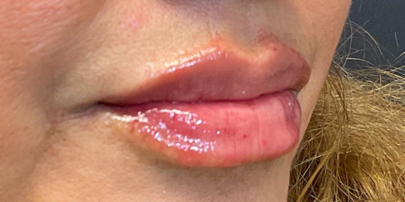 Lips Before & After Gallery - Patient 131839389 - Image 4