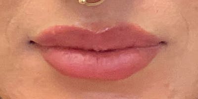 Lips Before & After Gallery - Patient 131839390 - Image 2