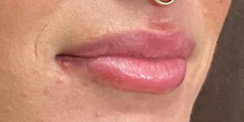 Lips Before & After Gallery - Patient 131839390 - Image 3