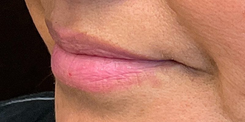 Lips Before & After Gallery - Patient 131839389 - Image 5