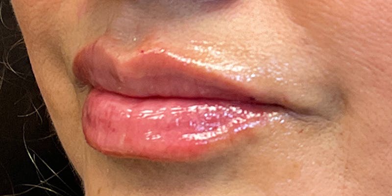 Lips Before & After Gallery - Patient 131839389 - Image 6