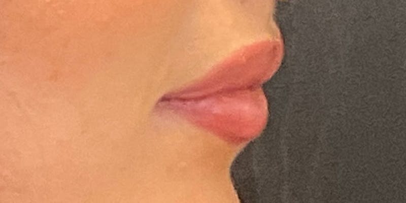 Lips Before & After Gallery - Patient 131839390 - Image 6