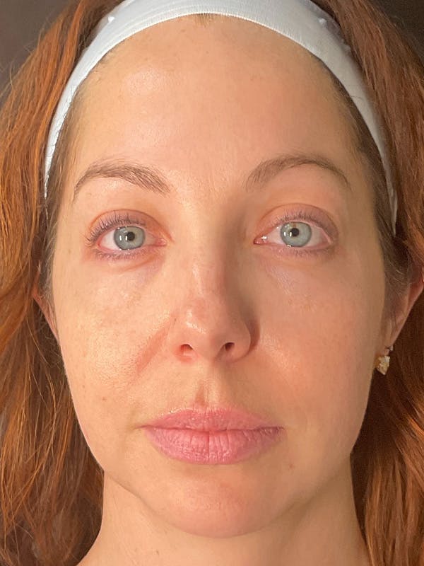 laser skin resurfacing