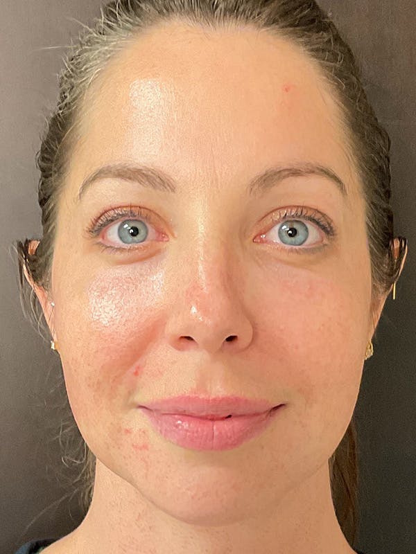 laser skin resurfacing