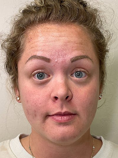 Skincare Before & After Gallery - Patient 131839898 - Image 1