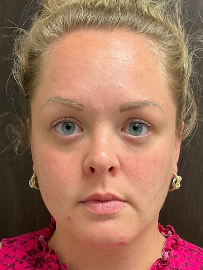 Skincare Before & After Gallery - Patient 131839898 - Image 2
