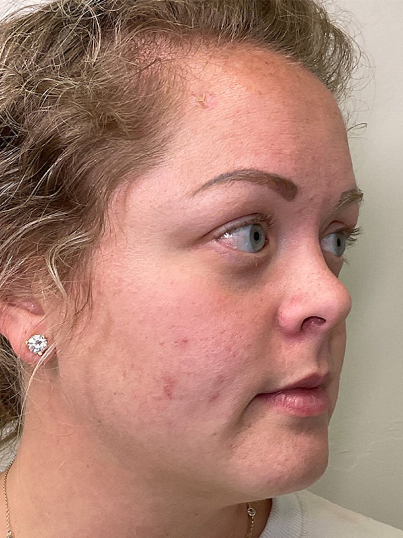 Skincare Before & After Gallery - Patient 131839898 - Image 3