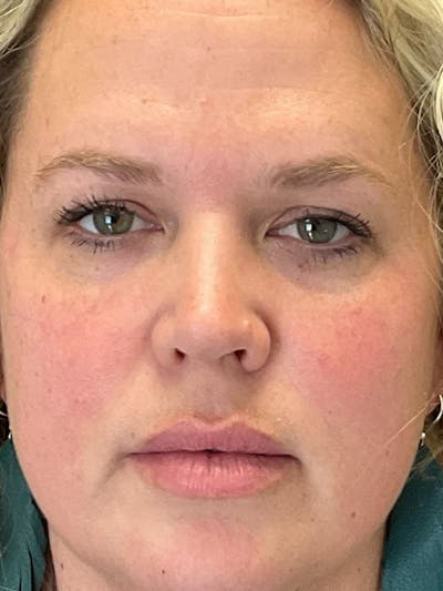 Skincare Before & After Gallery - Patient 131839900 - Image 2