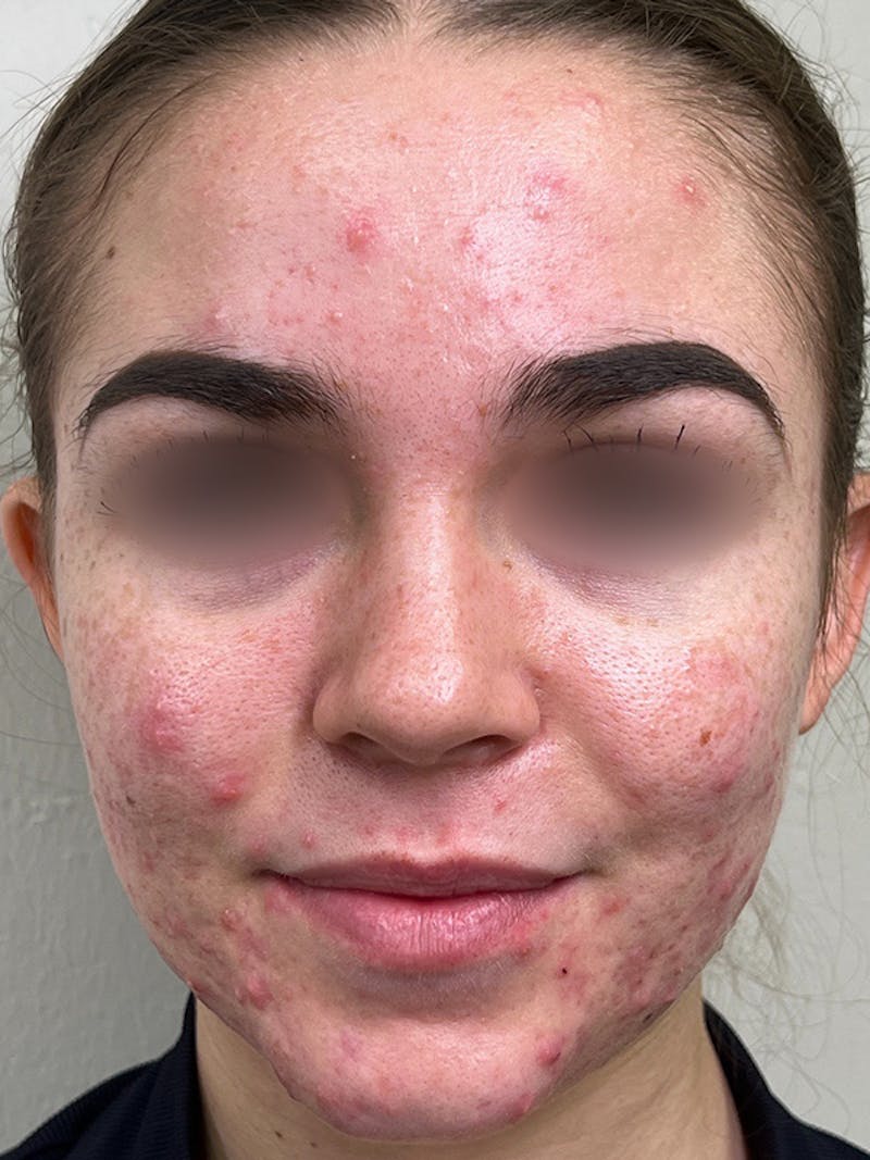 Skincare Before & After Gallery - Patient 131839901 - Image 1
