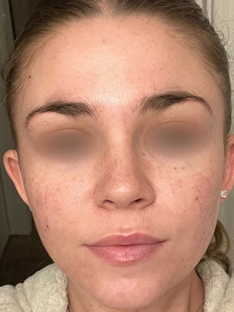 Skincare Before & After Gallery - Patient 131839901 - Image 2