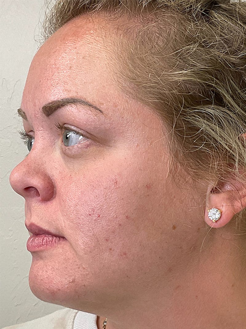 Skincare Before & After Gallery - Patient 131839898 - Image 7