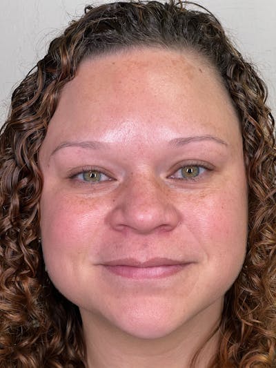 Morpheus8 Before & After Gallery - Patient 147392599 - Image 1