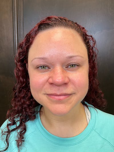 Morpheus8 Before & After Gallery - Patient 147392599 - Image 2