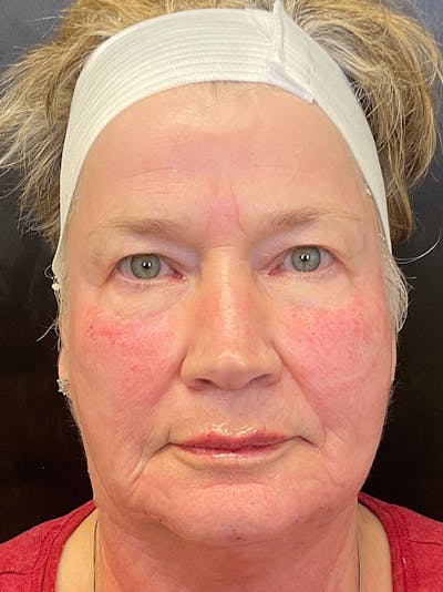 Full Face Filler Before & After Gallery - Patient 147494810 - Image 2