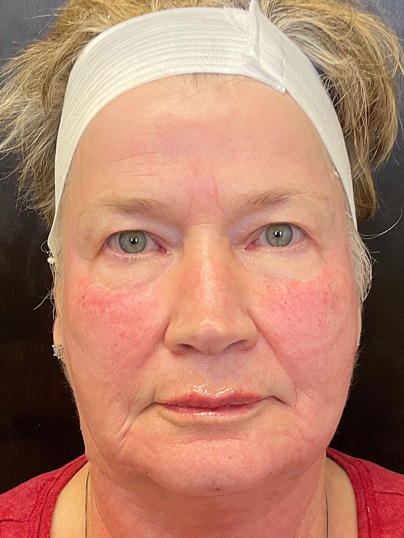 Full Face Filler Before & After Gallery - Patient 147494810 - Image 2