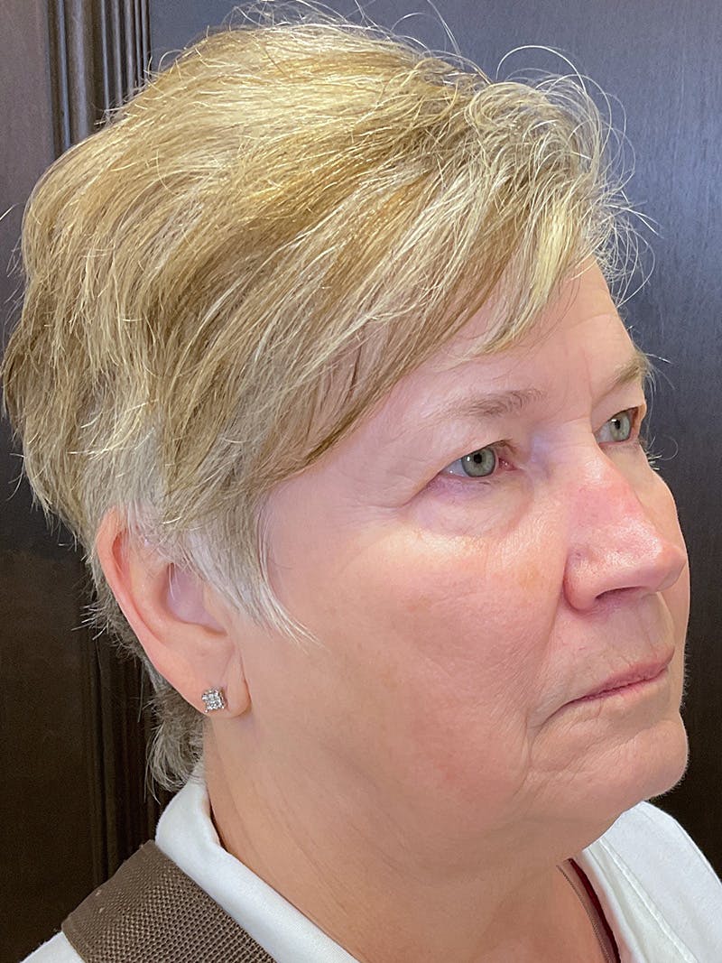 Full Face Filler Before & After Gallery - Patient 147494810 - Image 3