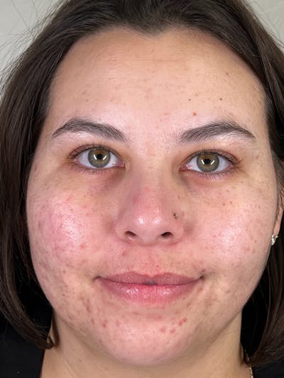 IPL Before & After Gallery - Patient 147644318 - Image 1