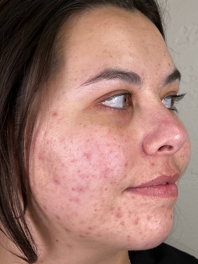 Skincare Before & After Gallery - Patient 147580341 - Image 3