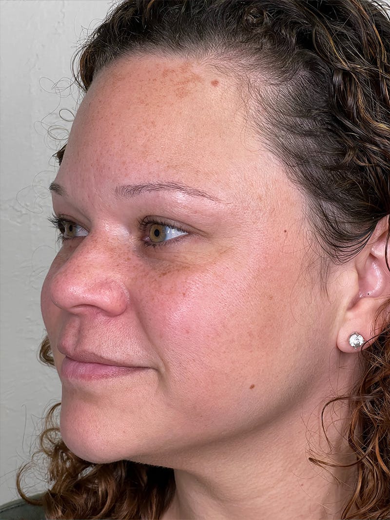 IPL Before & After Gallery - Patient 147738229 - Image 3