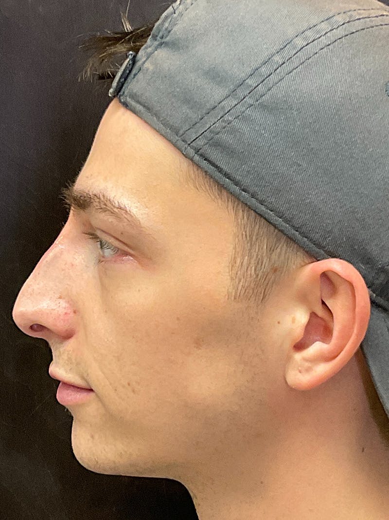 Full Face Filler Before & After Gallery - Patient 147615284 - Image 10