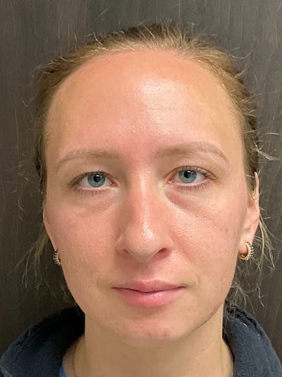 Full Face Filler Before & After Gallery - Patient 147616873 - Image 1