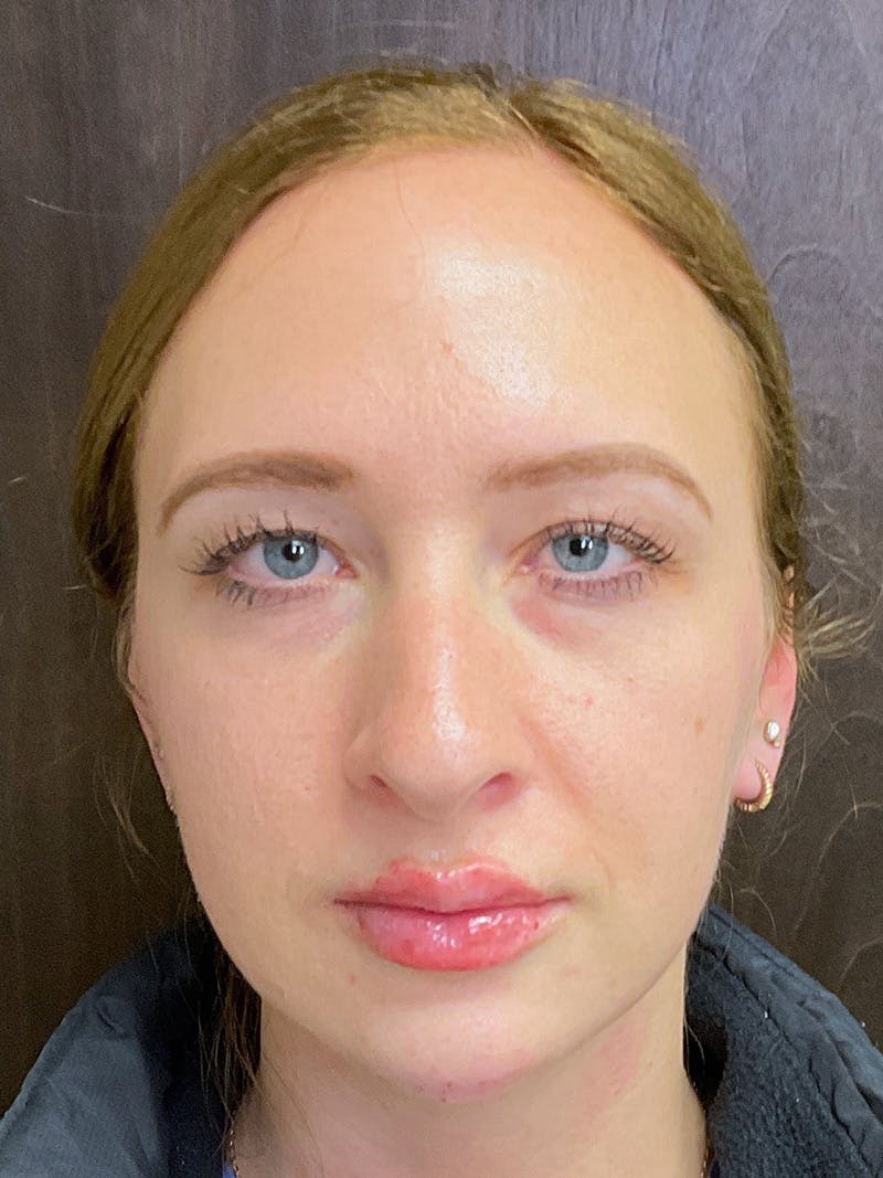 Juvederm