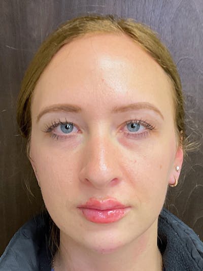 Full Face Filler Before & After Gallery - Patient 147616873 - Image 2