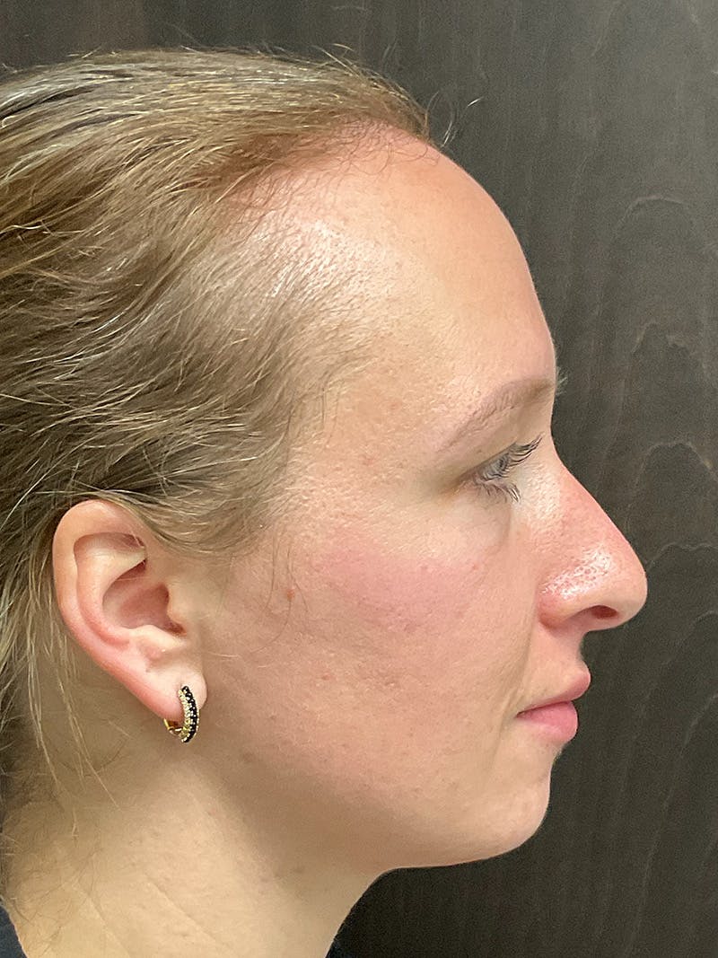 Full Face Filler Before & After Gallery - Patient 147616873 - Image 5