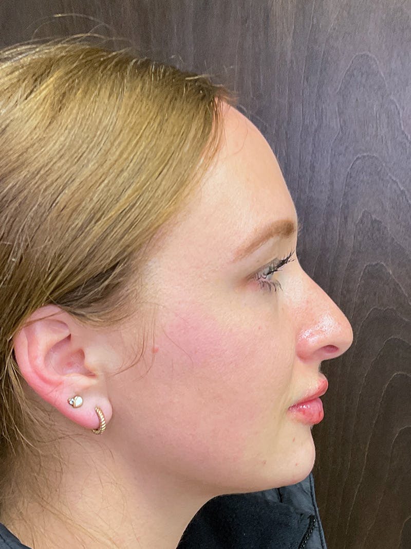 Full Face Filler Before & After Gallery - Patient 147616873 - Image 6