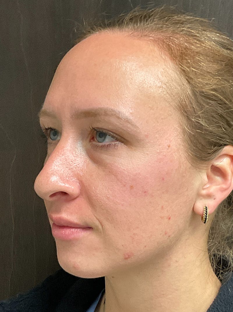 Full Face Filler Before & After Gallery - Patient 147616873 - Image 7