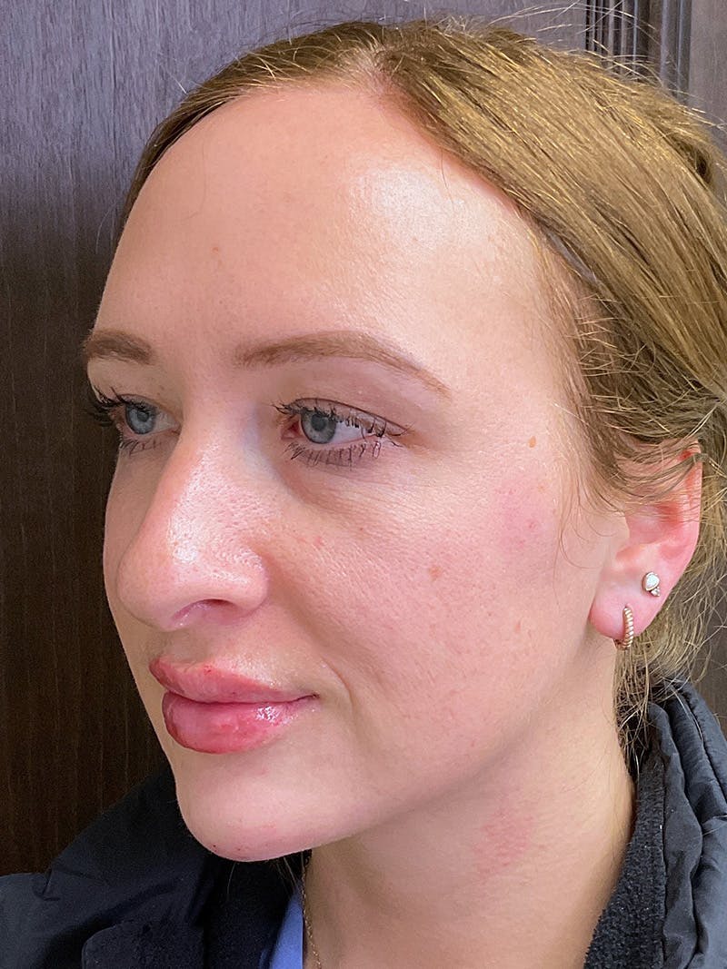 Full Face Filler Before & After Gallery - Patient 147616873 - Image 8
