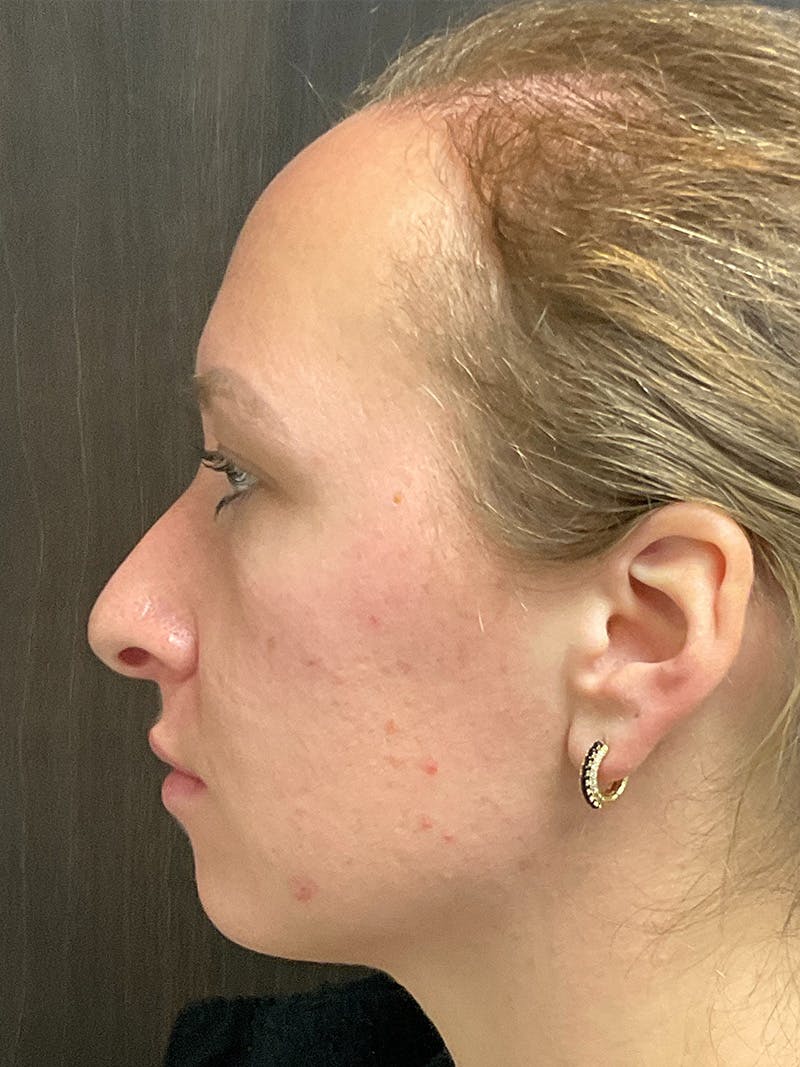 Full Face Filler Before & After Gallery - Patient 147616873 - Image 9