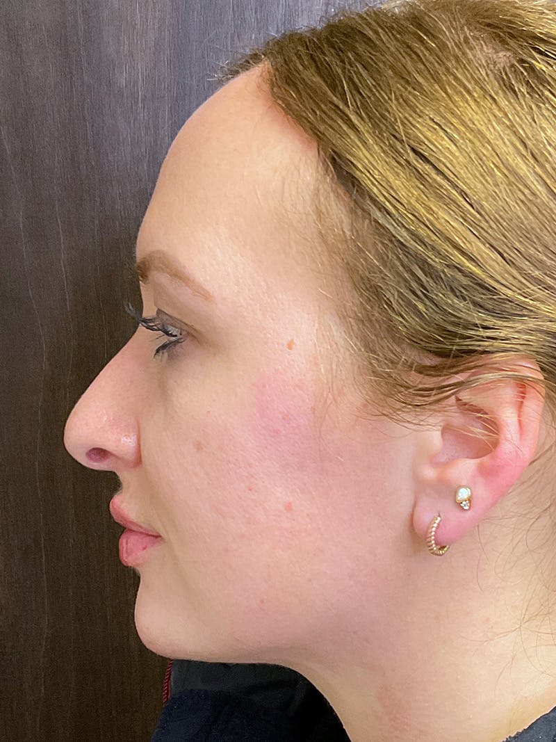 Full Face Filler Before & After Gallery - Patient 147616873 - Image 10