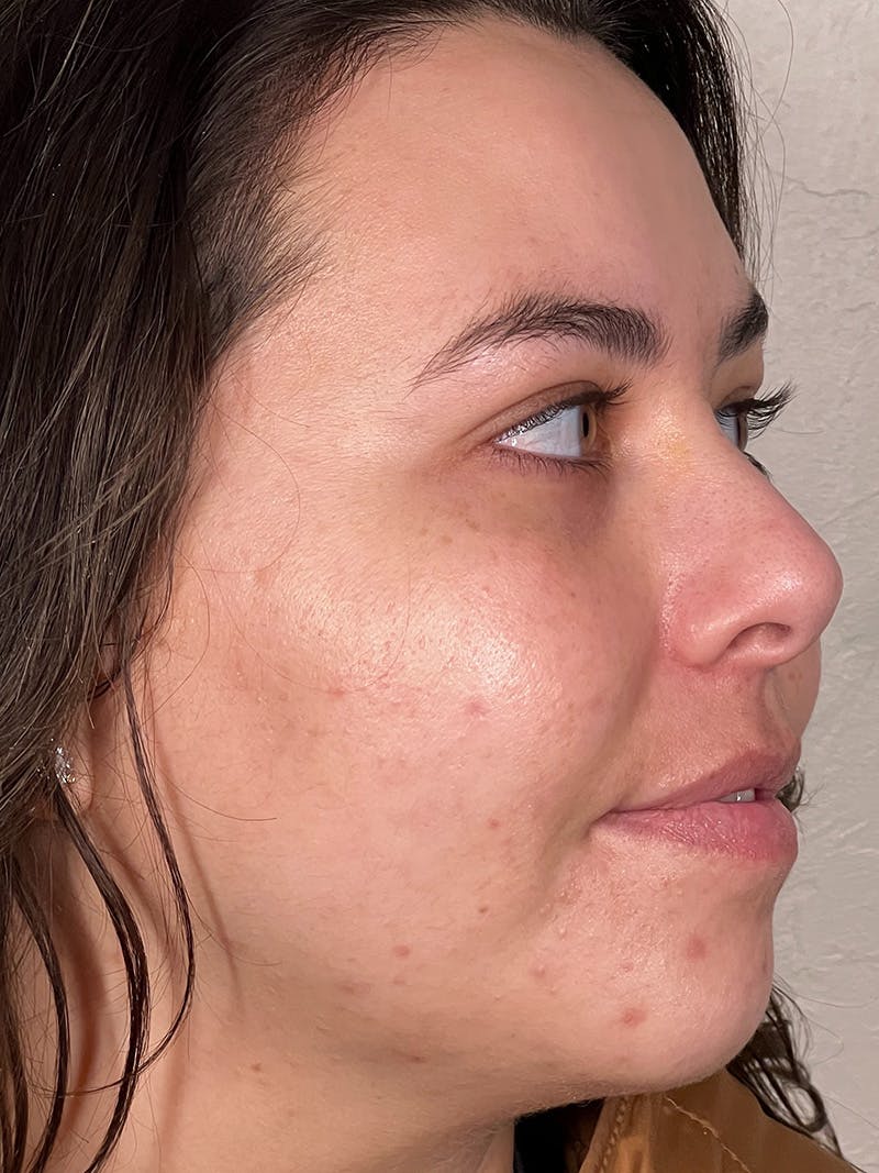 Skincare Before & After Gallery - Patient 147580341 - Image 4
