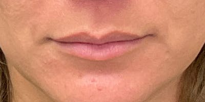 Lips Before & After Gallery - Patient 147694073 - Image 1