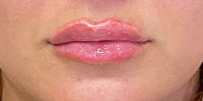 Lips Before & After Gallery - Patient 147694073 - Image 2