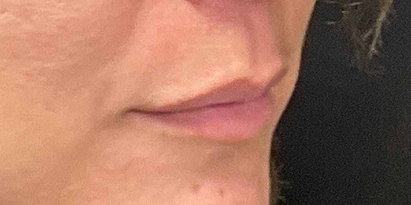 Lips Before & After Gallery - Patient 147694073 - Image 3