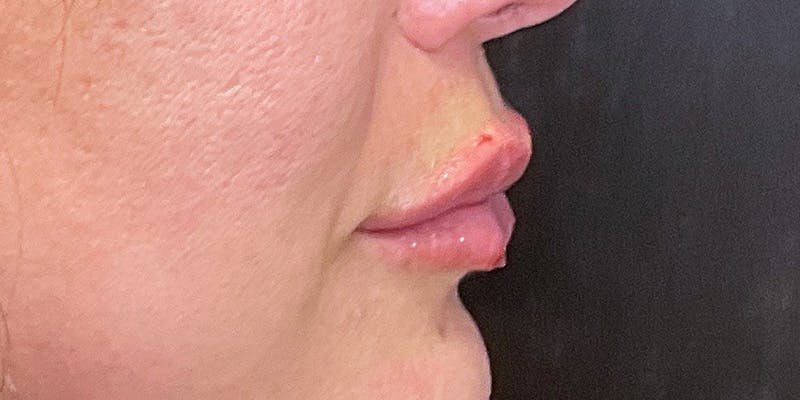 Lips Before & After Gallery - Patient 147694073 - Image 6