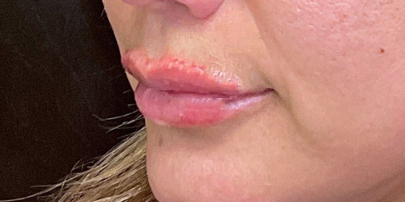 Lips Before & After Gallery - Patient 147694073 - Image 8