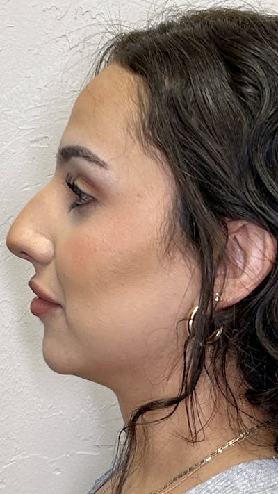 Nose Filler Before & After Gallery - Patient 147703804 - Image 1