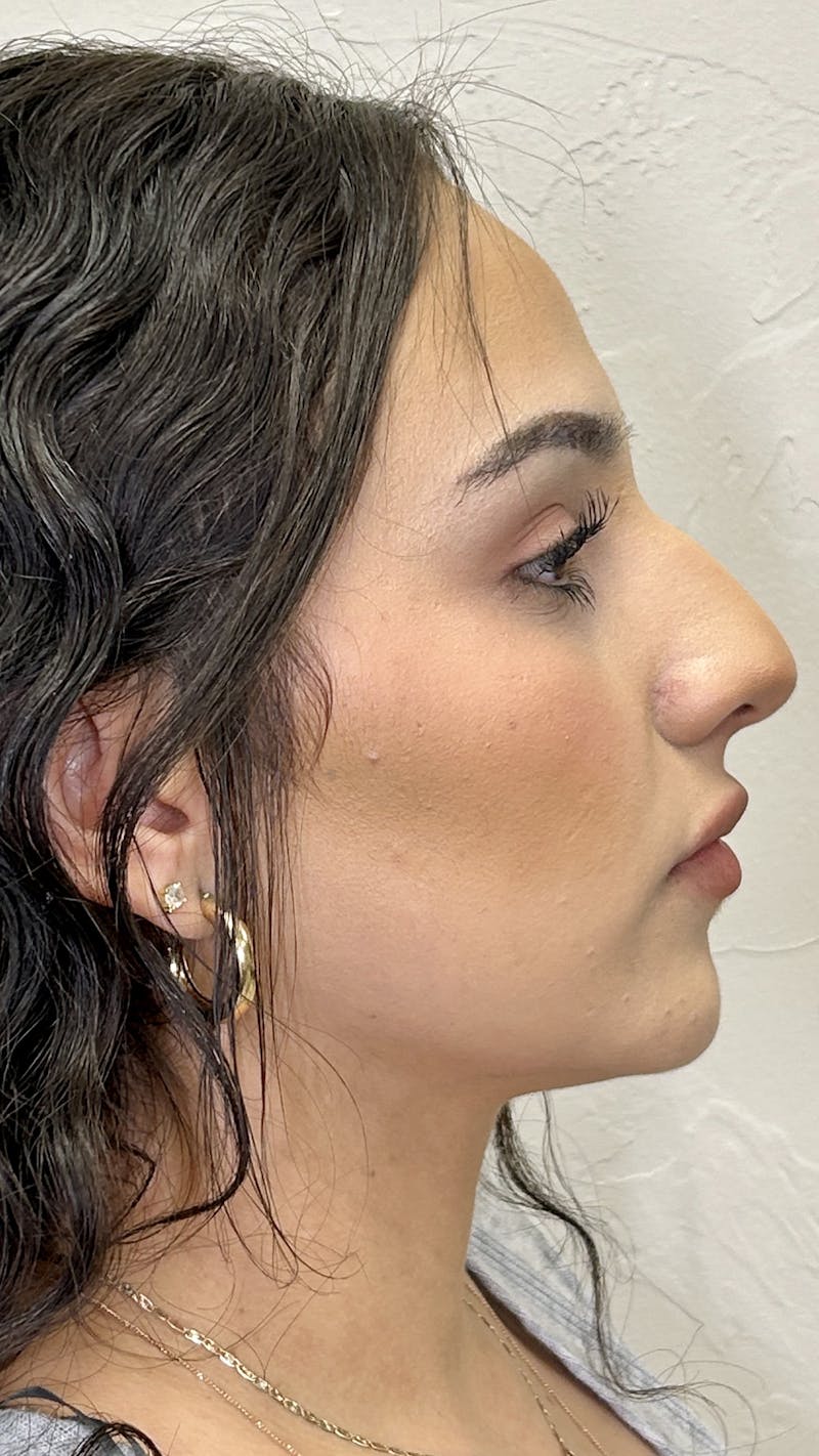Nose Filler Before & After Gallery - Patient 147703804 - Image 7