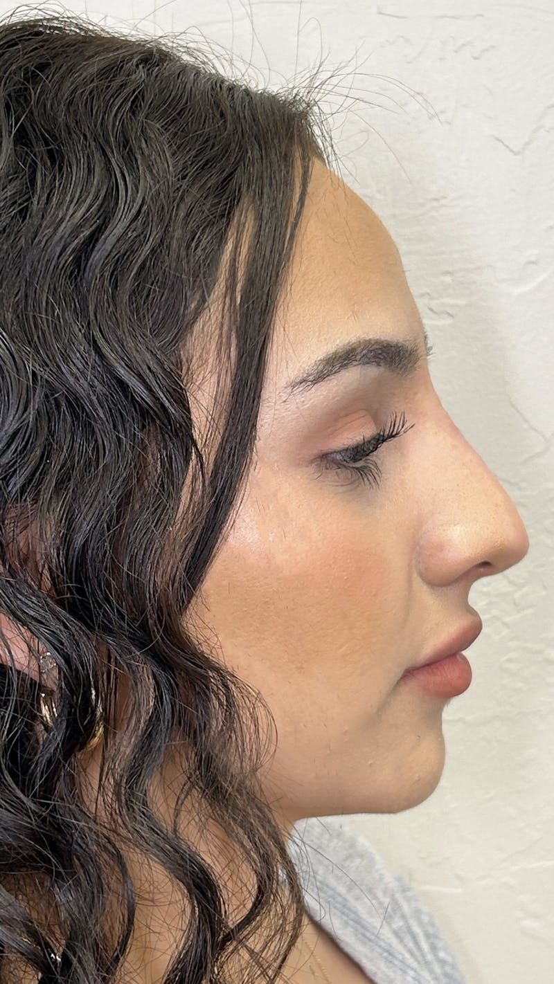 Nose Filler Before & After Gallery - Patient 147703804 - Image 8