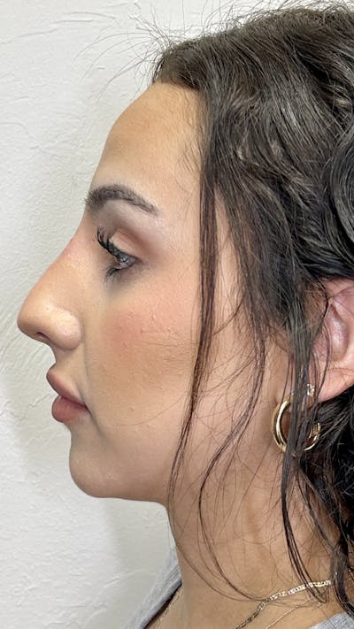 Nose Filler Before & After Gallery - Patient 147703804 - Image 2