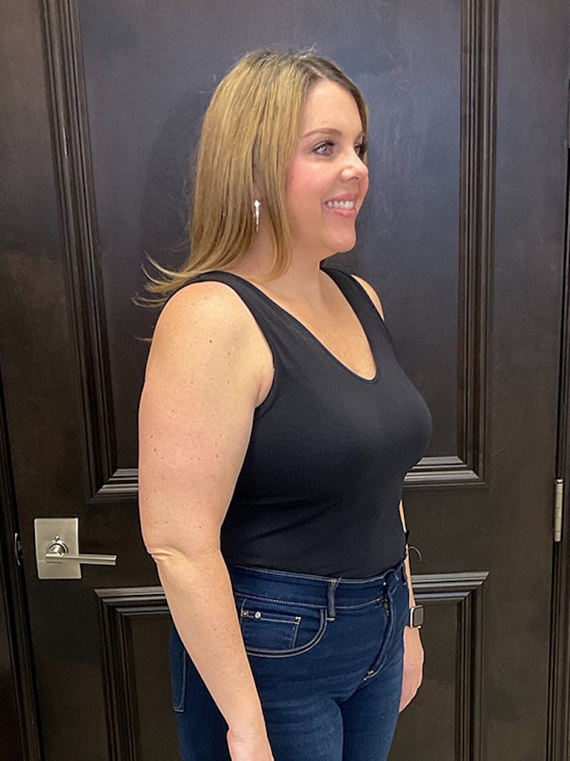 Semaglutide Before & After Gallery - Patient 147614844 - Image 8